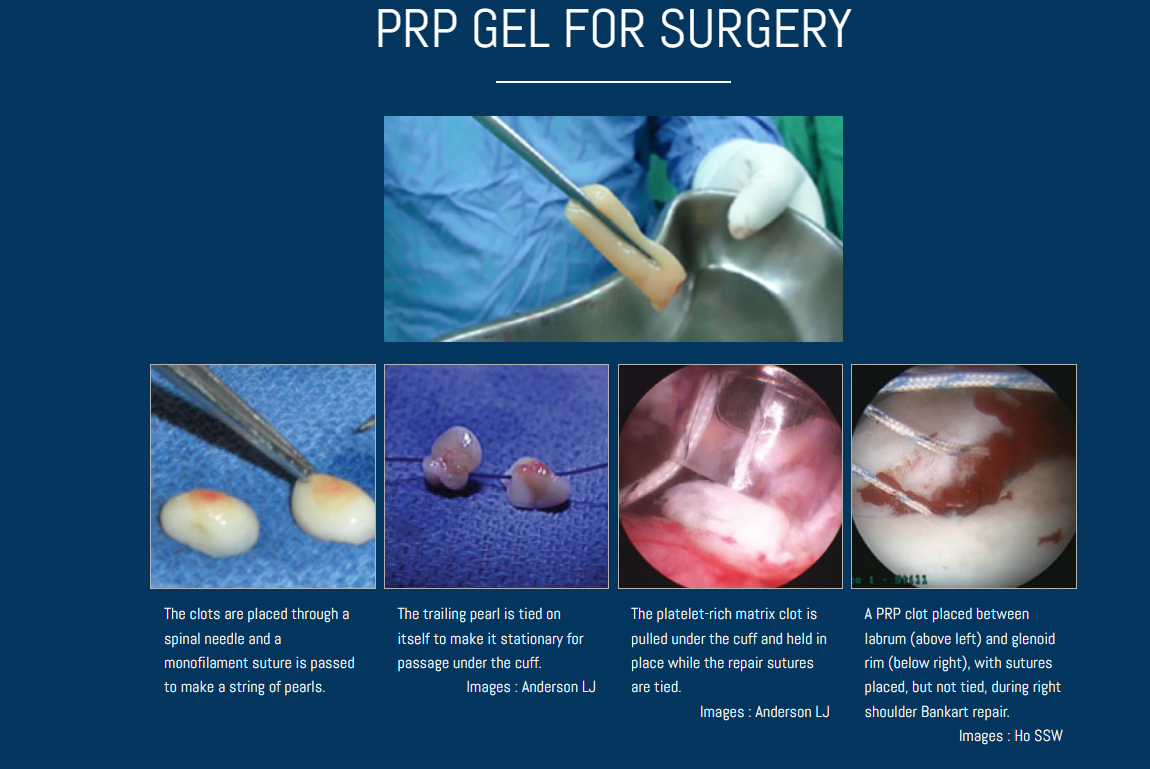 PRP GEL FOR SURGERY PRP GEL FOR SURGERY